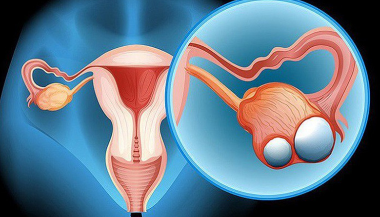 Ung thư phụ khoa (cổ tử cung, buồng trứng, tử cung) gây hẹp niệu quản